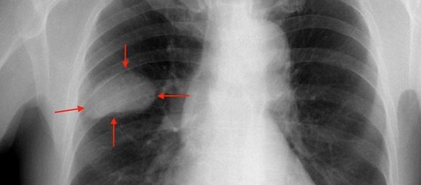 Cancer de pulmon