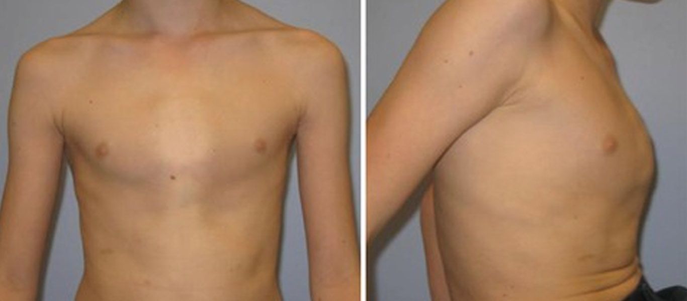Pectus carinatum